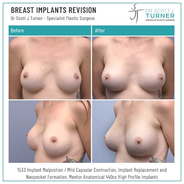 1533 Breast Implants Revision Before and After Photo Dr Scott Turner