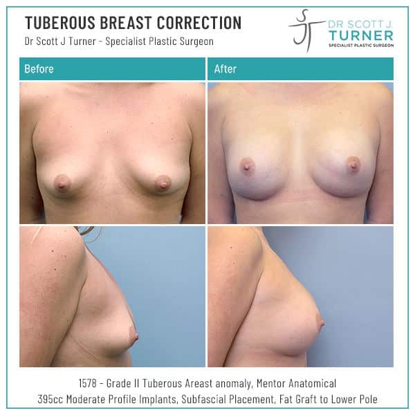 Tuberous Breast Correction Before and After Dr Turner Sydney
