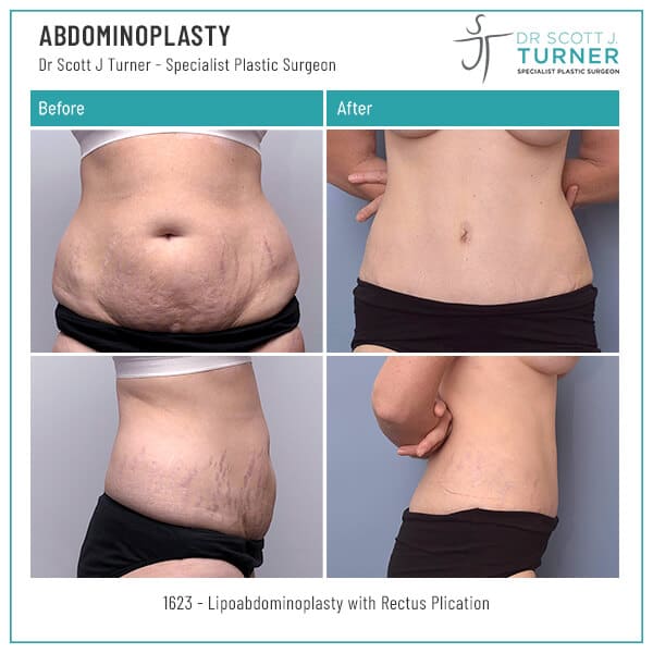 1623-Abdominoplasty-Before-and-After-Photo-Dr.-Scott-J-Turner