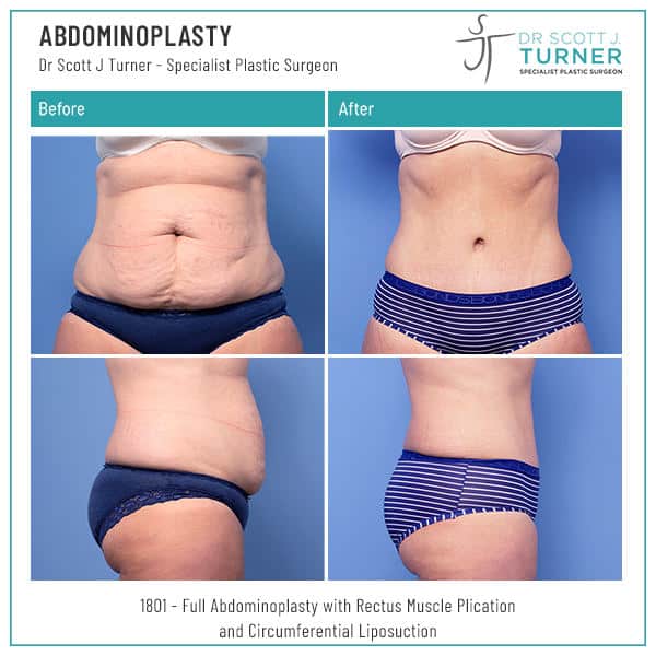 1801-Abdominoplasty-Before-and-After-Photo-Dr.-Scott-J-Turner