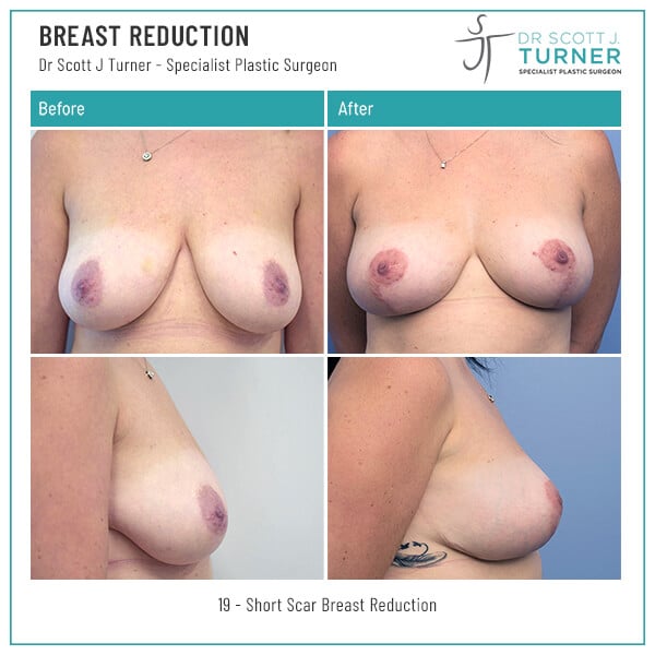 19-Breast-Reduction-Before-and-After-Photo-Dr.-Scott-J-Turner