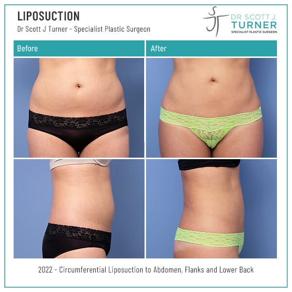 Liposuction-Before-and-After_Dr-Turner_Sydney