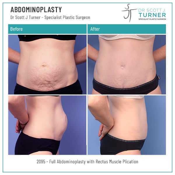 2095-Abdominoplasty-Before-and-After-Image-Dr.-Scott-J-Turner