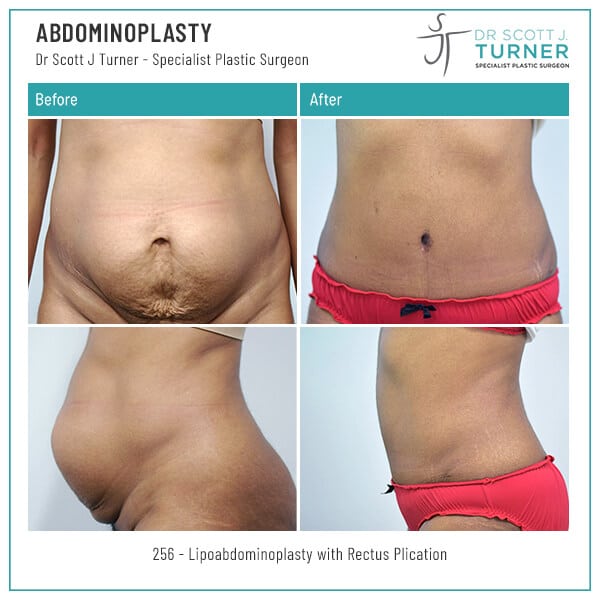 Abdominoplasty-Before-and-After_Dr-Turner_Sydney