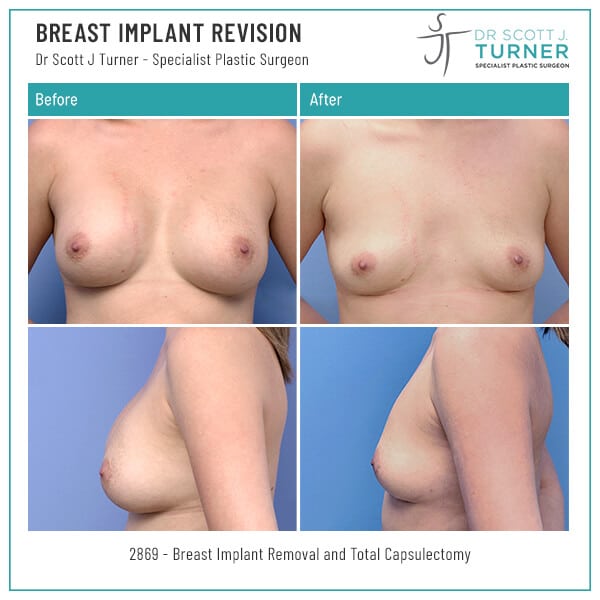 Breast-Implant-Revision-Before-and-After_Dr-Turner_Sydney