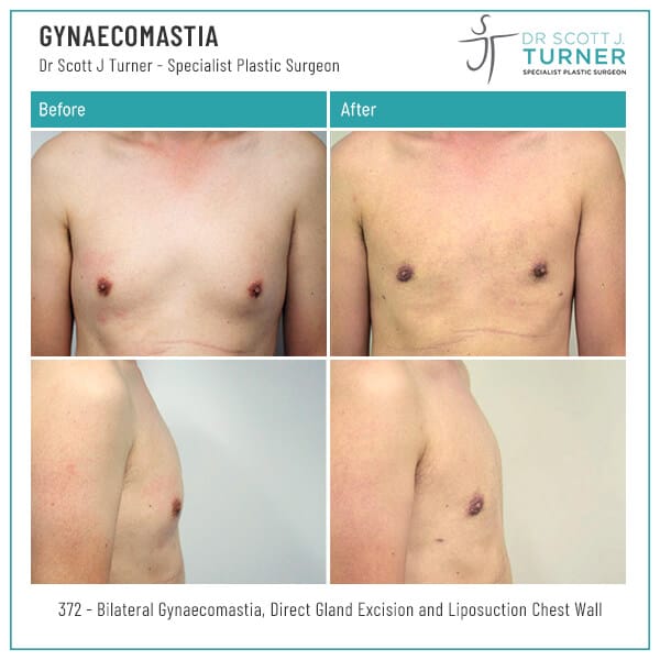 372-Gynaecomastia-Before-and-After-Photo-Dr.-Scott-J-Turner