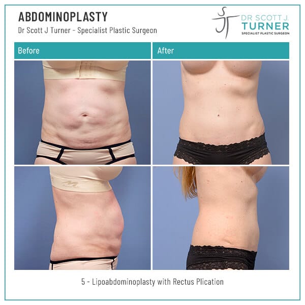 5-Abdominoplasty-Before-and-After-Photo-Dr.-Scott-J-Turner-1