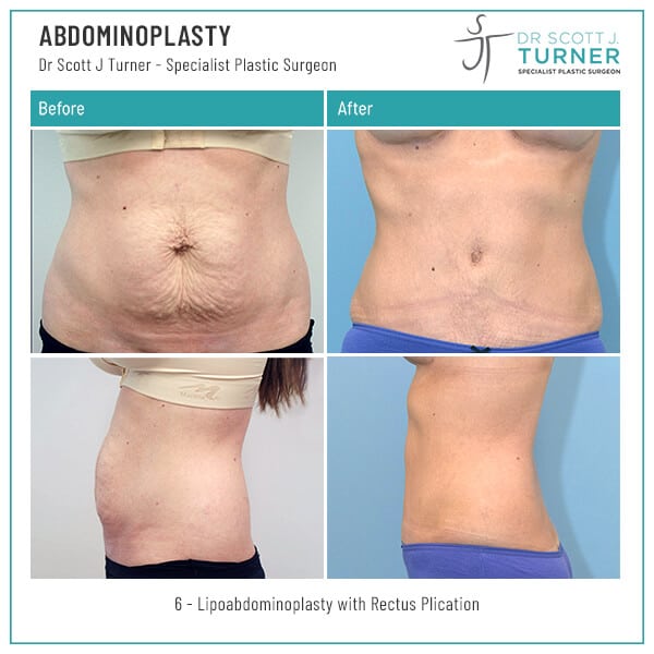 6-Abdominoplasty-Before-and-After-Photo-Dr.-Scott-J-Turner-1