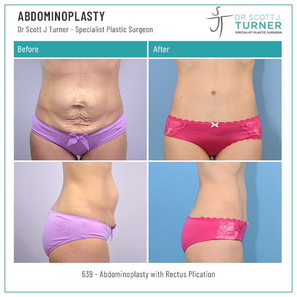 639-Abdominoplasty-Before-and-After-Photo-Dr.-Scott-J-Turner