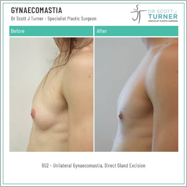 652 Gynaecomastia Before and After Side by Dr-Scott Turner Plastic Surgeon Scaled