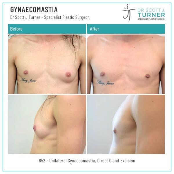 652 Gynaecomastia Dr. Scott J Turner Before and After Photo