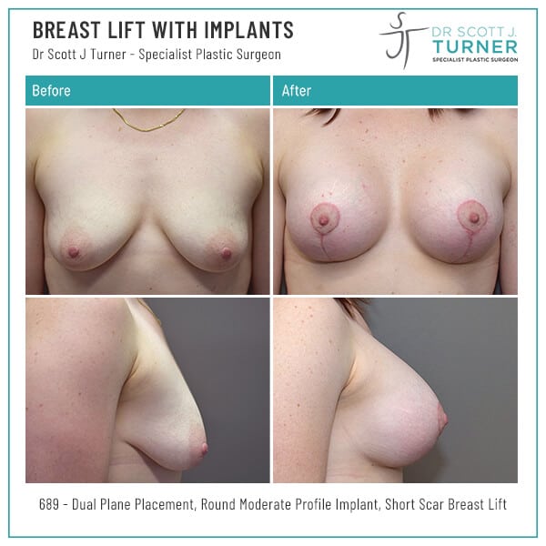 689-Breast-Lift-with-Implants-Before-and-After-Photo-Dr.-Scott-J-Turner
