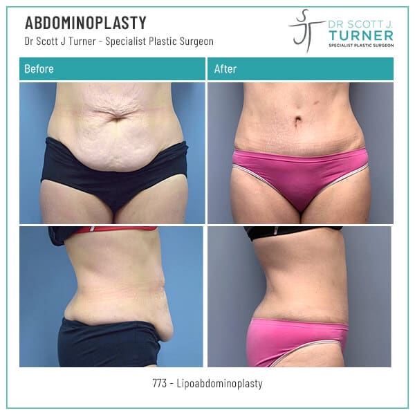 773-Abdominoplasty-Before-and-After-Photo-Dr.-Scott-J-Turner