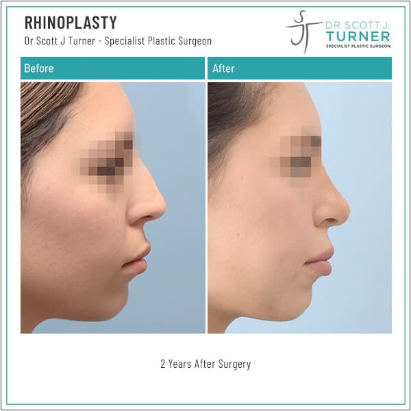 848-Rhino-Before-and-After-by-Dr-Scott-Turner-Plastic-Surgeon-Melbourne