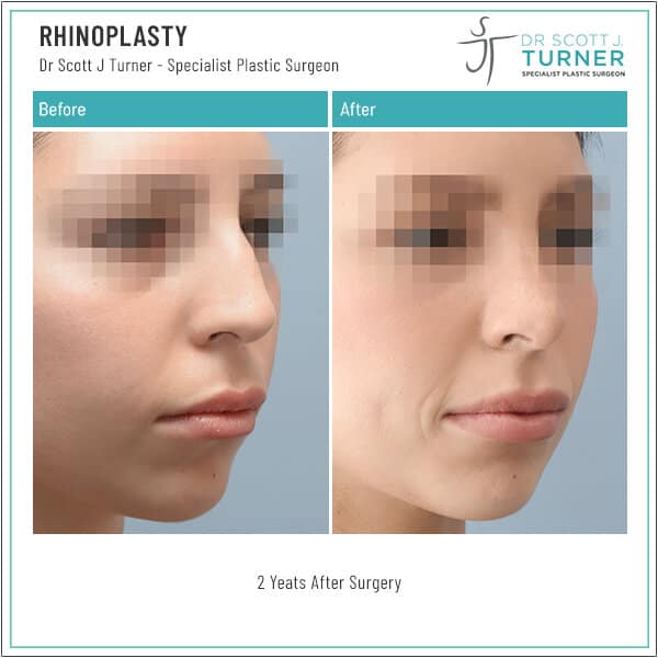 848 Rhinoplasty Before and After Photo Dr Scott Turner Plastic Surgeon Melbourne