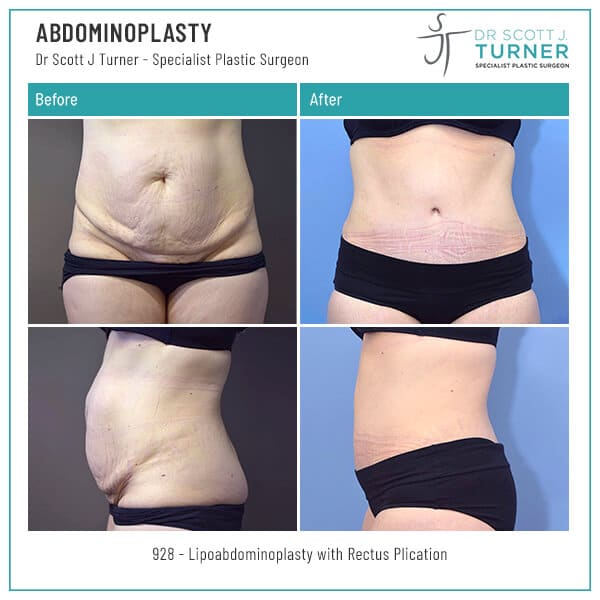 928-Abdominoplasty-Before-and-After-Photo-Dr.-Scott-J-Turner