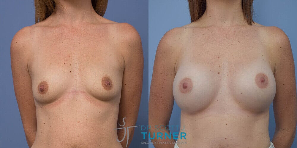 Best Boob Job Sydney Breast Augmentation Newcastle 2006a Before and After Photos Dr Scott Turner Leading Best Breast Surgeon Sydney Breast Implants Australia