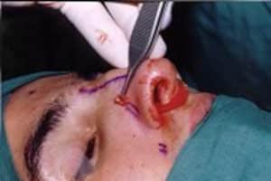 Dr Paul O’Keeffe Template Rhinoplasty Operation 3