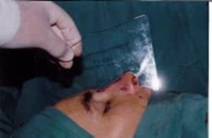 Dr Paul O’Keeffe Template Rhinoplasty Operation 4