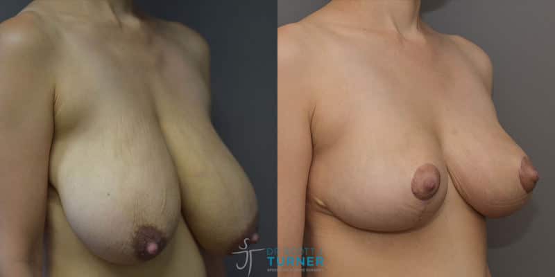 Breast-lift-with-implants_Dr-Turner_Sydney