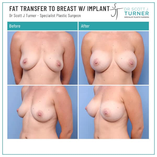 Fat-transfer-to-breast-with-implant-Before-and-After_Dr-Turner_Sydney