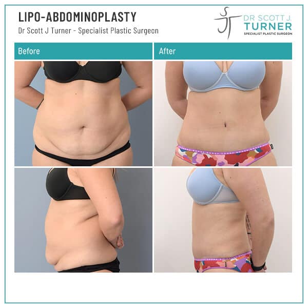 Lipo Abdominoplasty Before and After Photo Dr Scott Turner