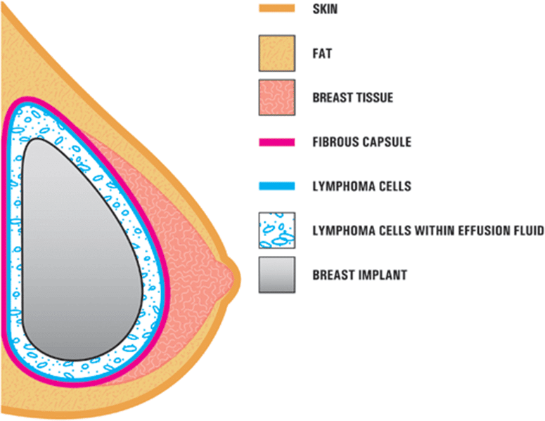 Symptoms-diagnosis-and-treatment-of-breast-implant-associated-cancer-BIA-ALCL-Illustration_Dr-Turner_Sydney