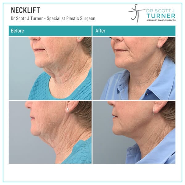 female-necklift-Before-and-After_Dr-Turner_Sydney