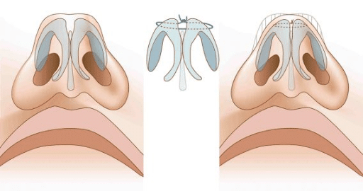 Tip refinement sutures