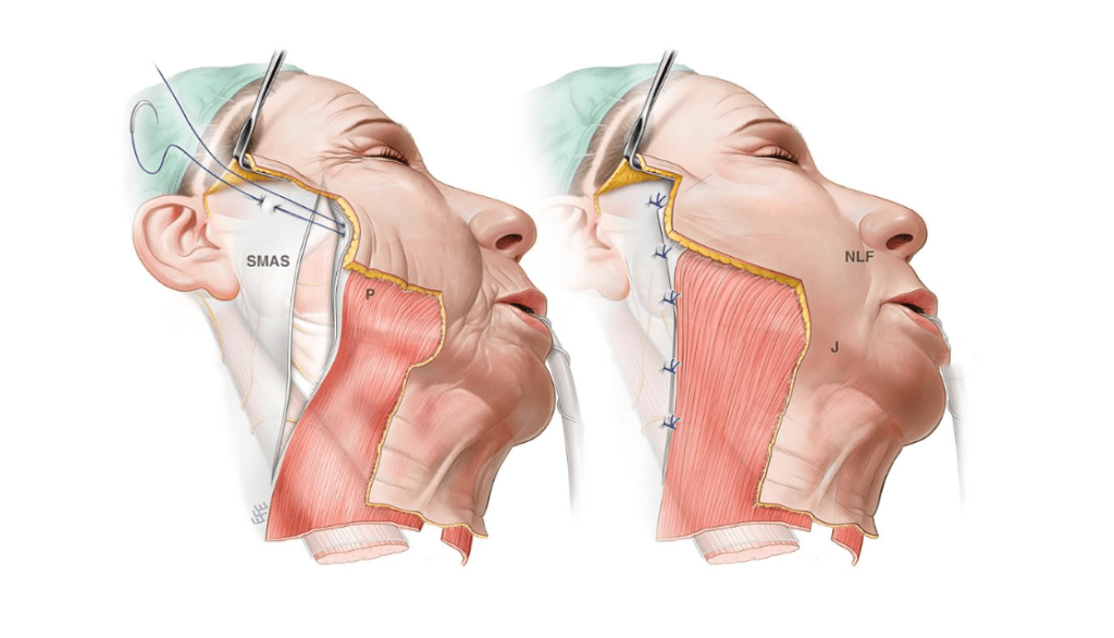 Deep Plane Facelift
