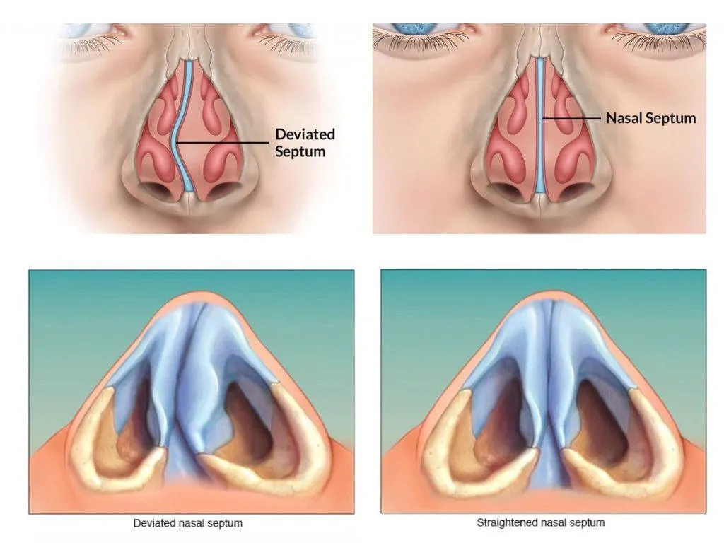 Deviated Septum