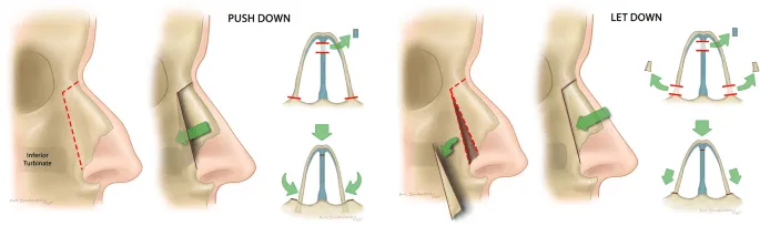 Preservation Rhinoplasty Techniques
