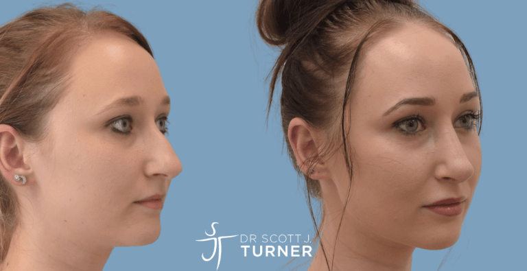 Primary Rhinoplasty - Dorsal Hump Reduction, Shorten Nasal Length, Rotate Nasal Tip