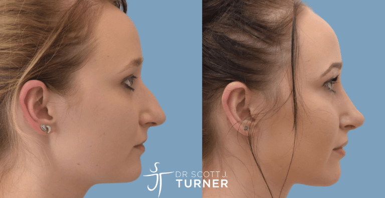 Primary Rhinoplasty - Dorsal Hump Reduction, Shorten Nasal Length, Rotate Nasal Tip