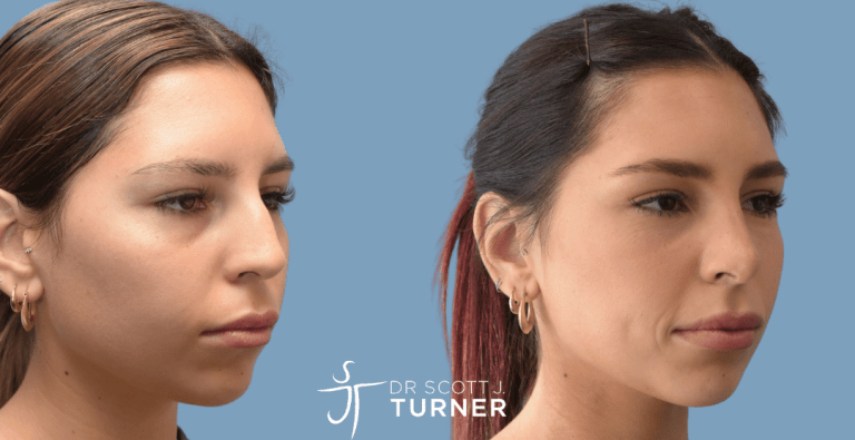Primary Rhinoplasty - Dorsal Hump Reduction, Slim Nasal Profile