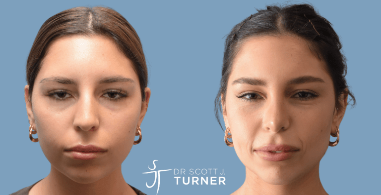 Primary Rhinoplasty - Dorsal Hump Reduction, Slim Nasal Profile