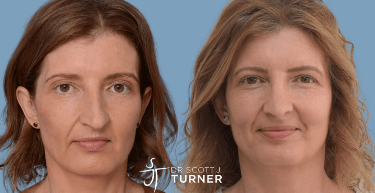 Functional Rhinoplasty - Straighten Nasal Profile, Septoplasty, Dorsal Hump Reduction, Spreader Grafts, Shorten Nasal Length, Rotate Nasal Tip & Decrease Tip Projection