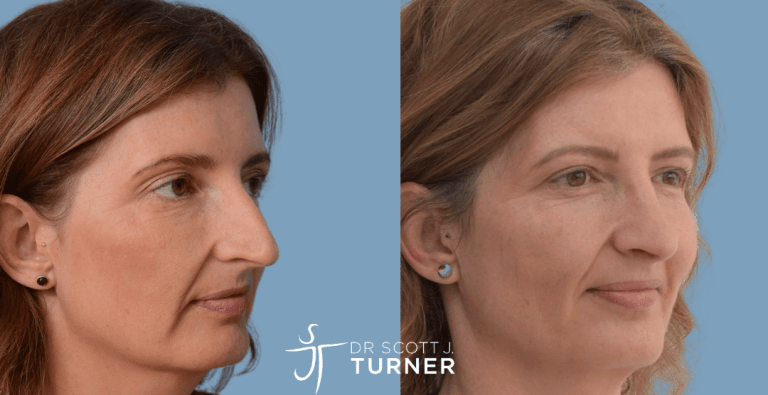 Functional Rhinoplasty - Straighten Nasal Profile, Septoplasty, Dorsal Hump Reduction, Spreader Grafts, Shorten Nasal Length, Rotate Nasal Tip & Decrease Tip Projection