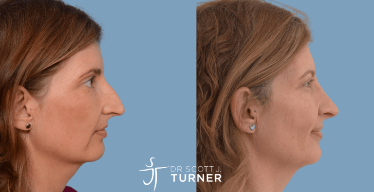 Functional Rhinoplasty - Straighten Nasal Profile, Septoplasty, Dorsal Hump Reduction, Spreader Grafts, Shorten Nasal Length, Rotate Nasal Tip & Decrease Tip Projection
