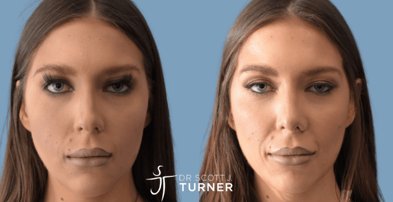 Primary Rhinoplasty - Dorsal Hump Reduction, Tip Refinement