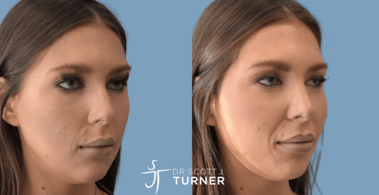Primary Rhinoplasty - Dorsal Hump Reduction, Tip Refinement