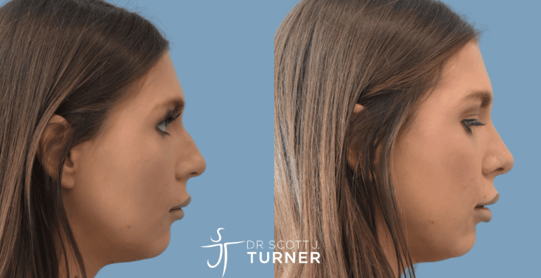 Primary Rhinoplasty - Dorsal Hump Reduction, Tip Refinement