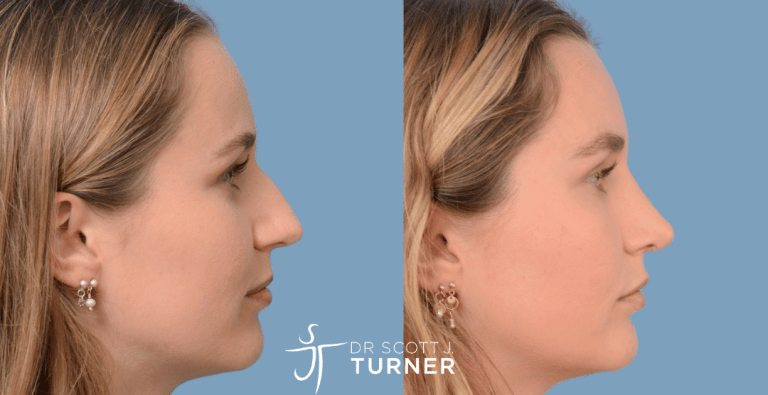 Primary Rhinoplasty - Dorsal Hump Reduction, Tip Refinement