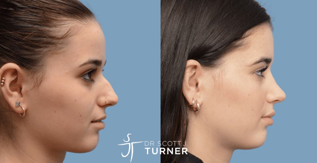 Rhinoplasty Before and After