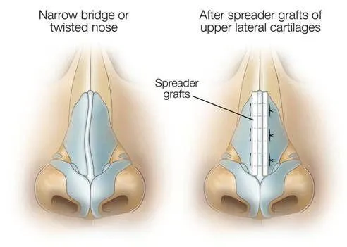 Spreader Grafts
