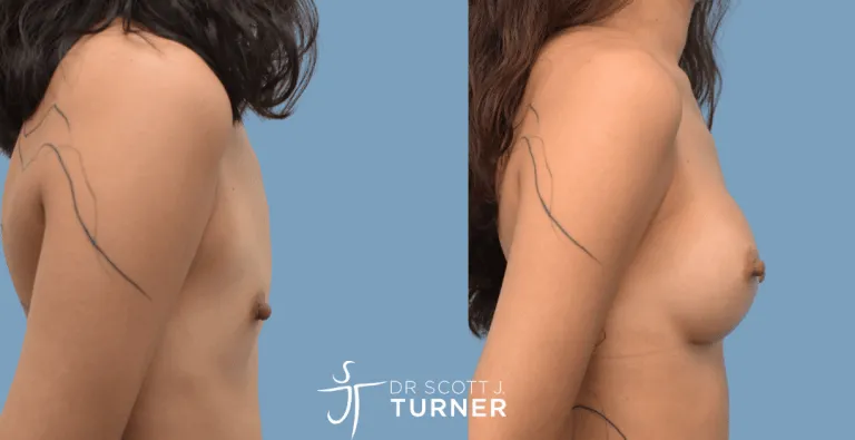 Breast Augmentation, Motiva Round Breast Implants, Customized Dual Plane, Photos Taken at 9 months Postoperatively