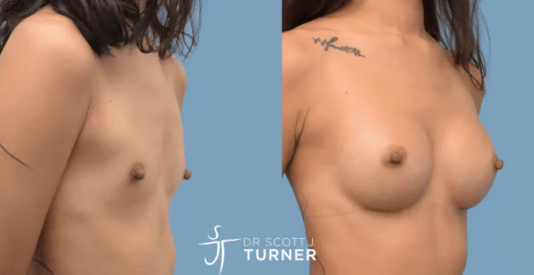 Breast Augmentation, Motiva Round Breast Implants, Customized Dual Plane, Photos Taken at 9 months Postoperatively
