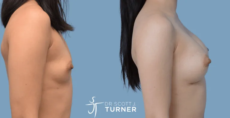 Breast Augmentation, Anatomical Moderate Plus Profile Implants, Customized Dual Plane Placement, Photos Taken at 8 months Postoperatively