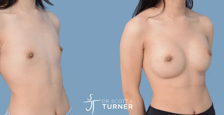 Asian Breast Augmentation, Anatomical Moderate Profile Implants, Customized Dual Plane Placement, Photos Taken at 12 months Postoperatively