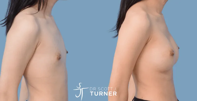 Asian Breast Augmentation, Anatomical Moderate Profile Implants, Customized Dual Plane Placement, Photos Taken at 12 months Postoperatively